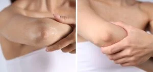 Woman,with,dry,skin,on,elbow,before,and,after,moisturizing Woman,with,dry,skin,on,elbow,before,and,after,moisturizing